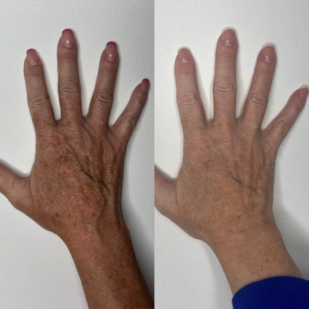 IPL Photofacial before and after and reduction in redness and brown lesions on hands.png