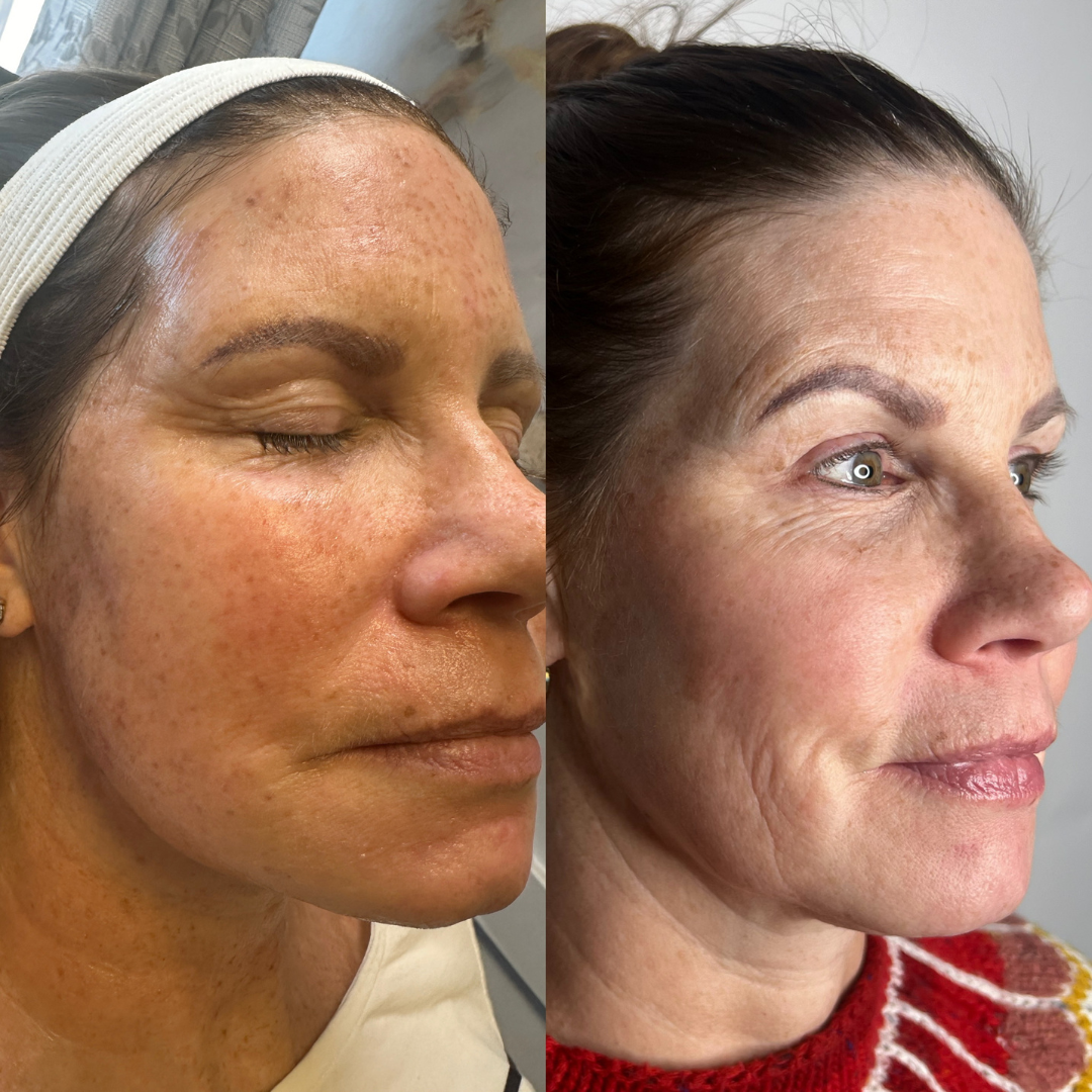ess and brown lesions at Dream Medspa.png
