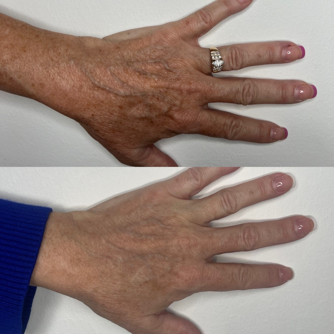 IPL Photofacial