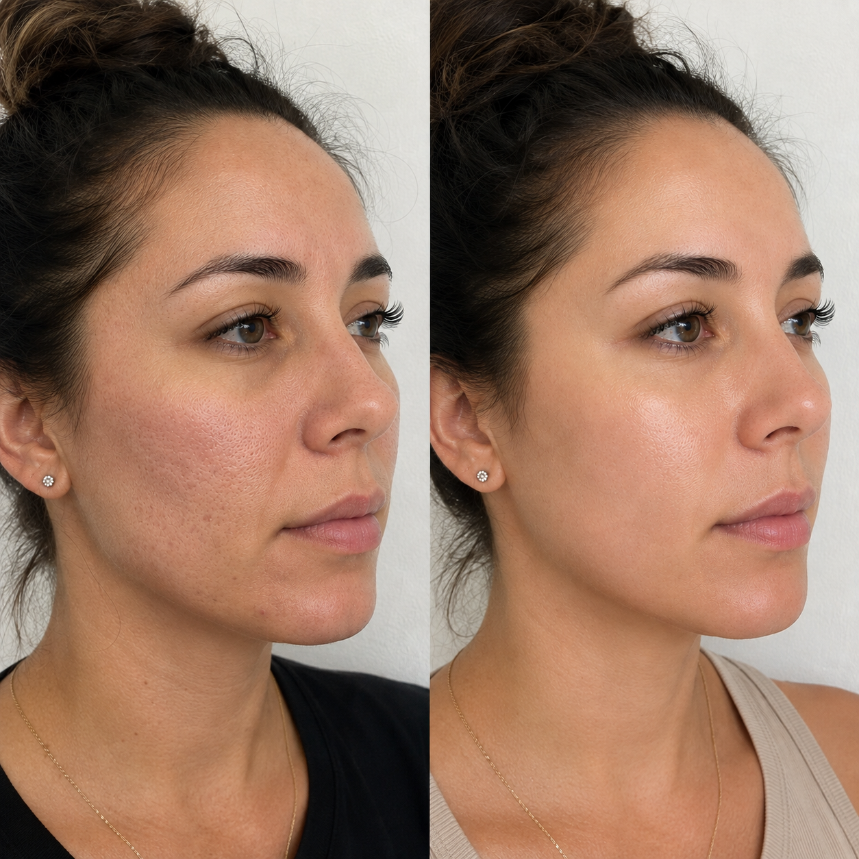 acne scars treated with microneedling.png