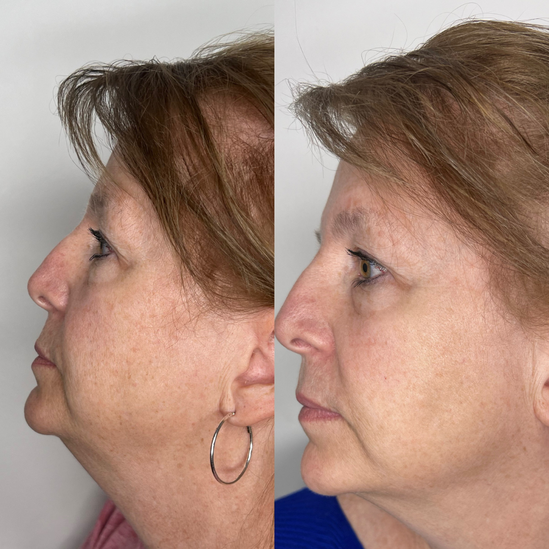 IPL Photofacial