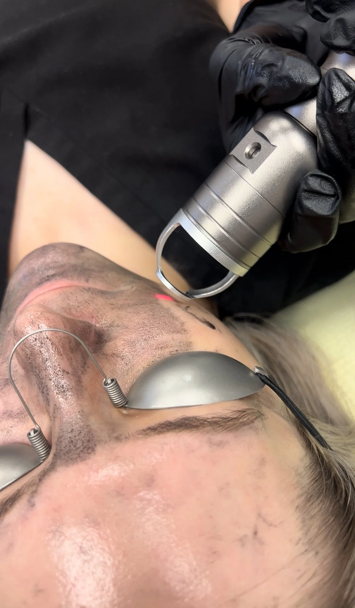 A person receiving a facial treatment with a microdermabrasion device, with a technician using a handheld tool, wearing black gloves, to exfoliate the skin on their face.