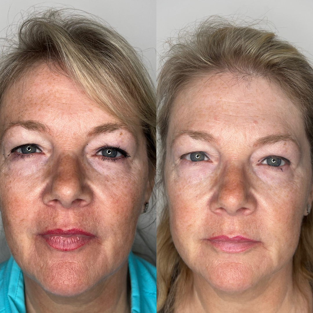 IPL Photofacial