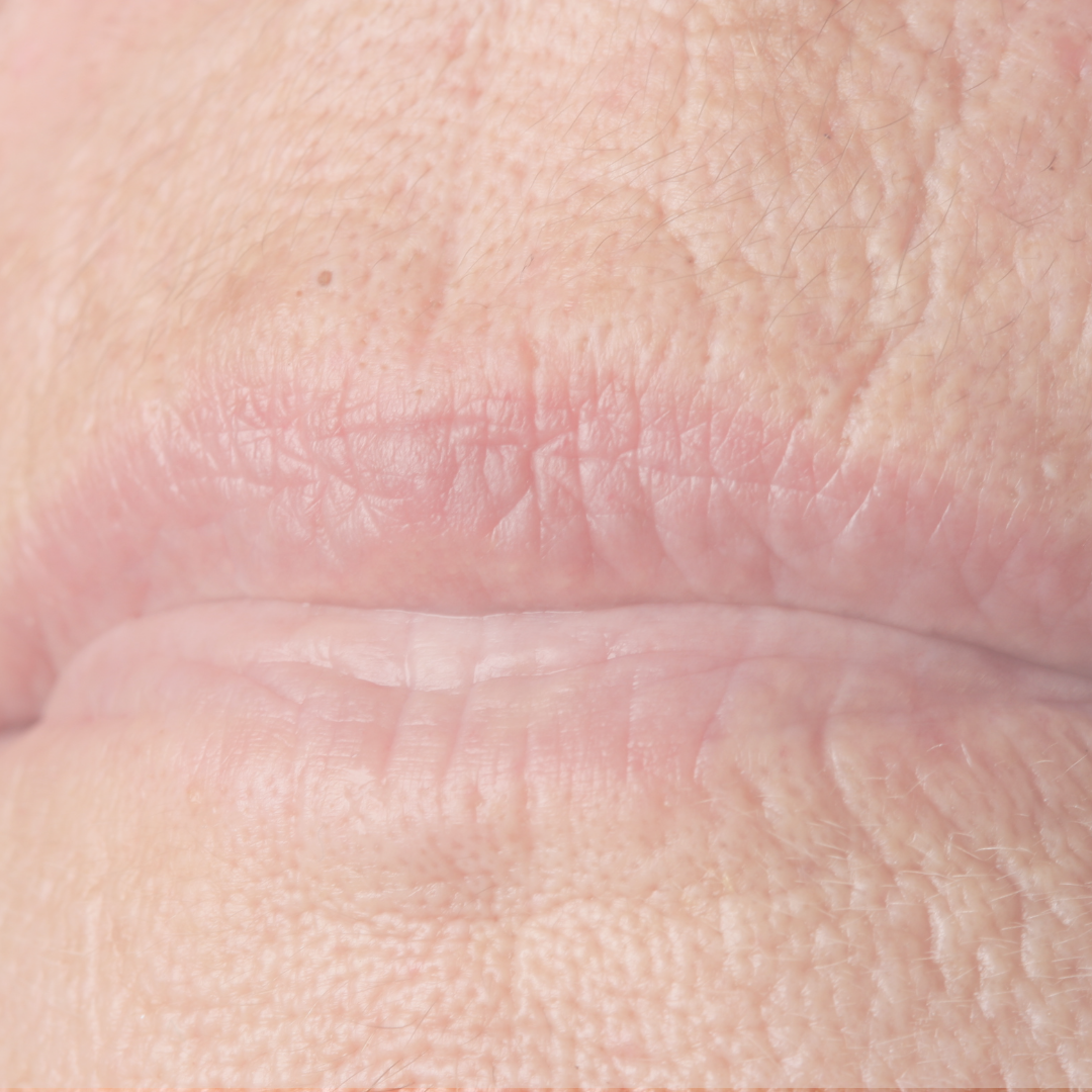 Lip Line Treatment in Denver | Smooth Smoker’s Lines & Wrinkles ...