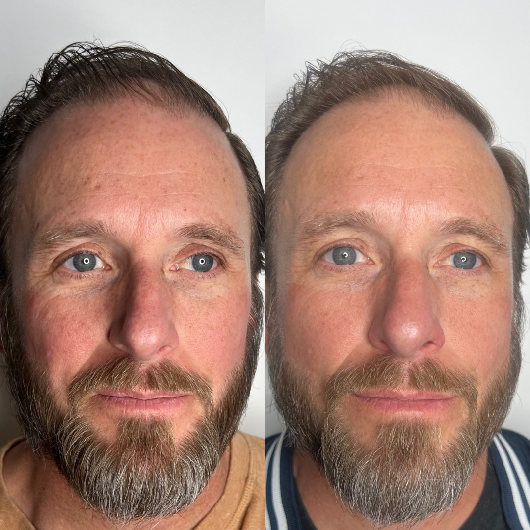 IPL Photofacial