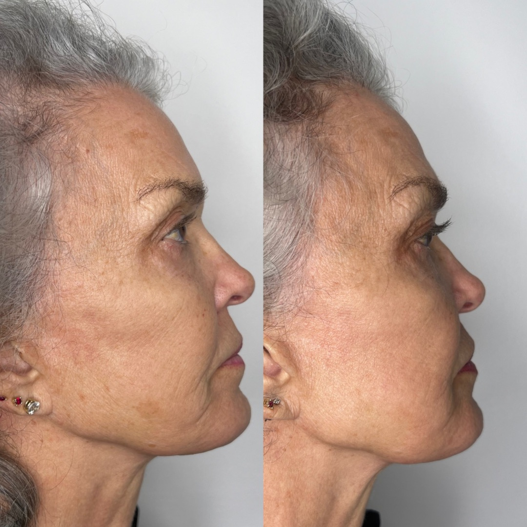 IPL Photofacial