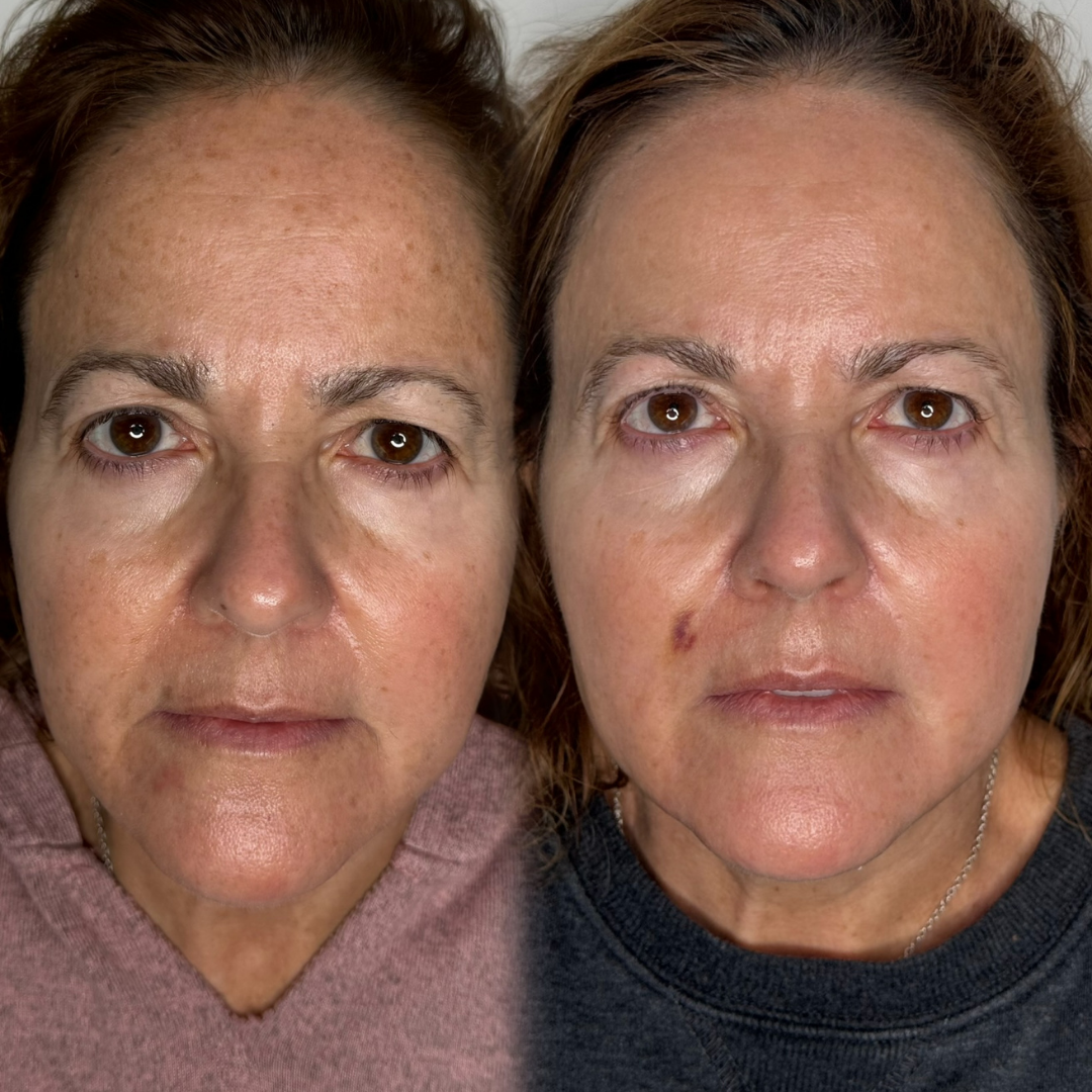 IPL Photofacial