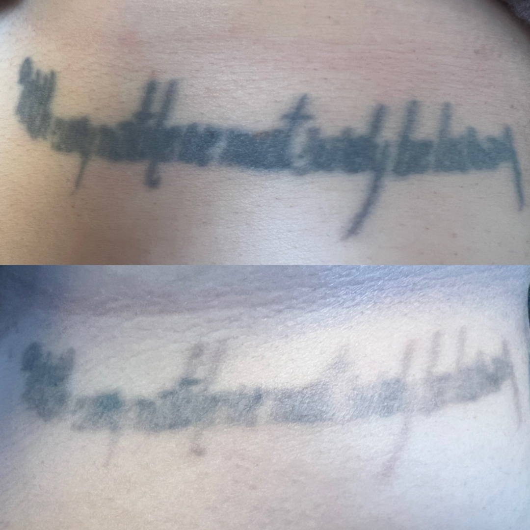 Laser Tattoo Removal