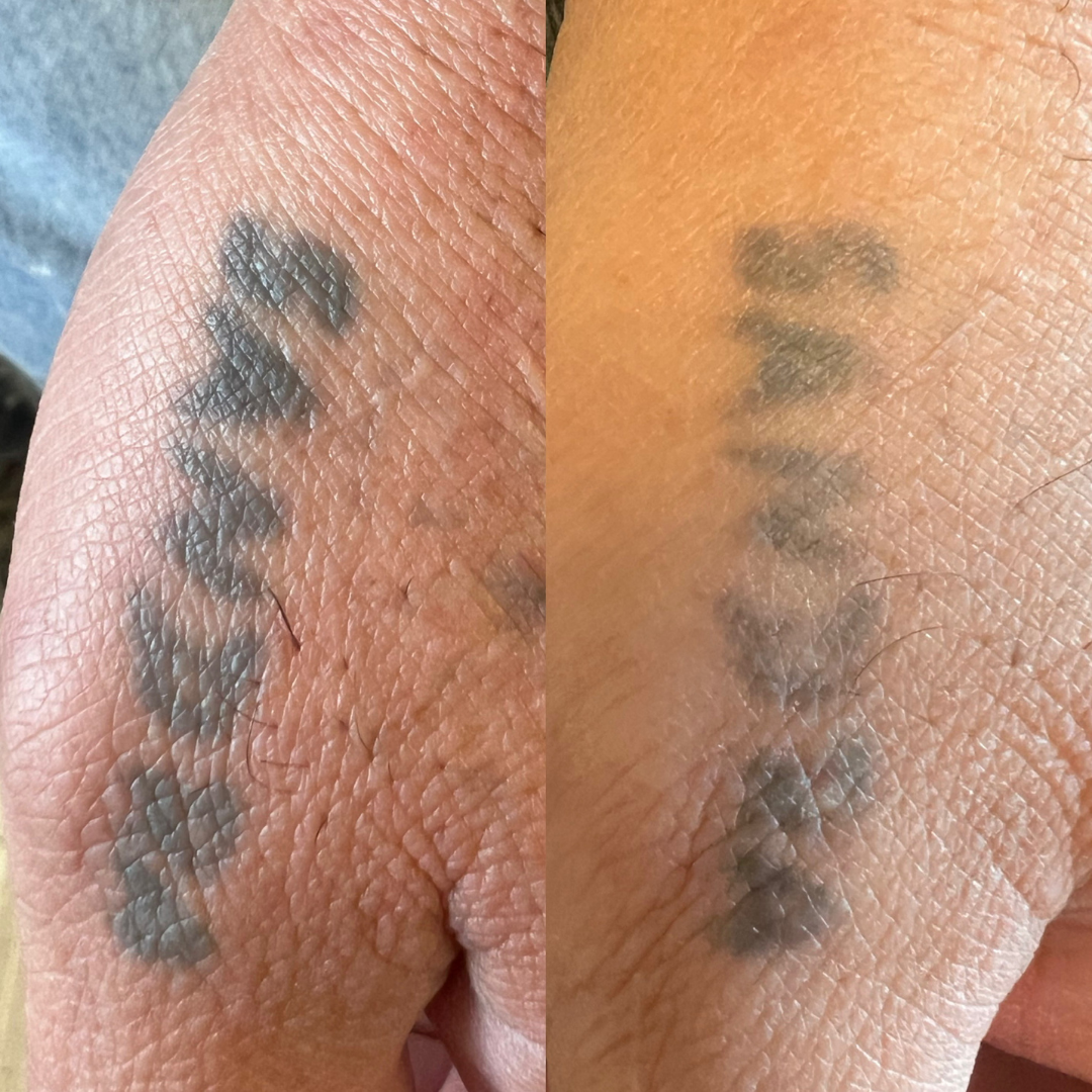 Laser Tattoo Removal