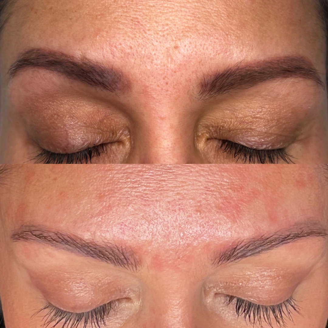 Laser Tattoo Removal on Eyebrows.PNG