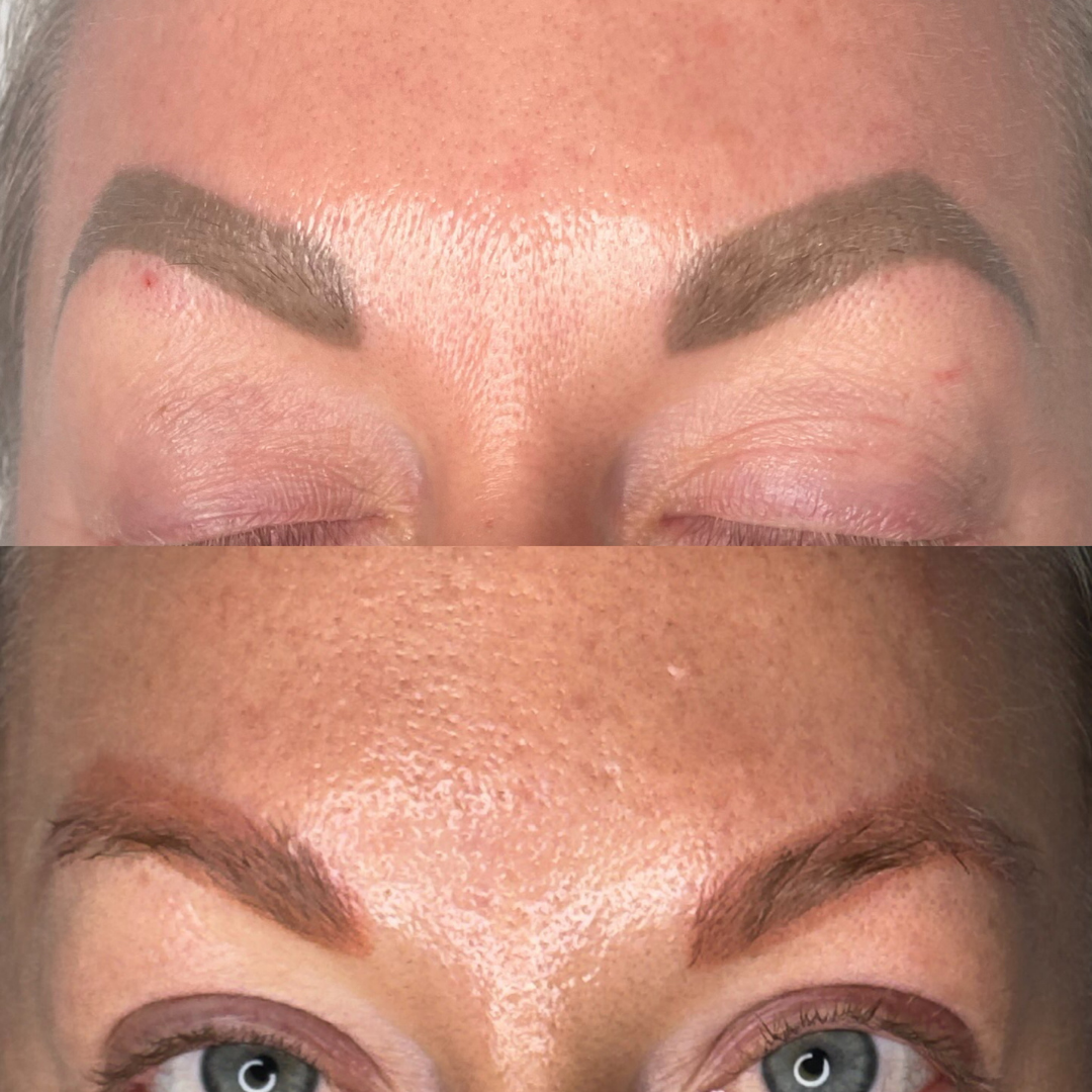 Laser Tattoo Removal for Permanent Makeup