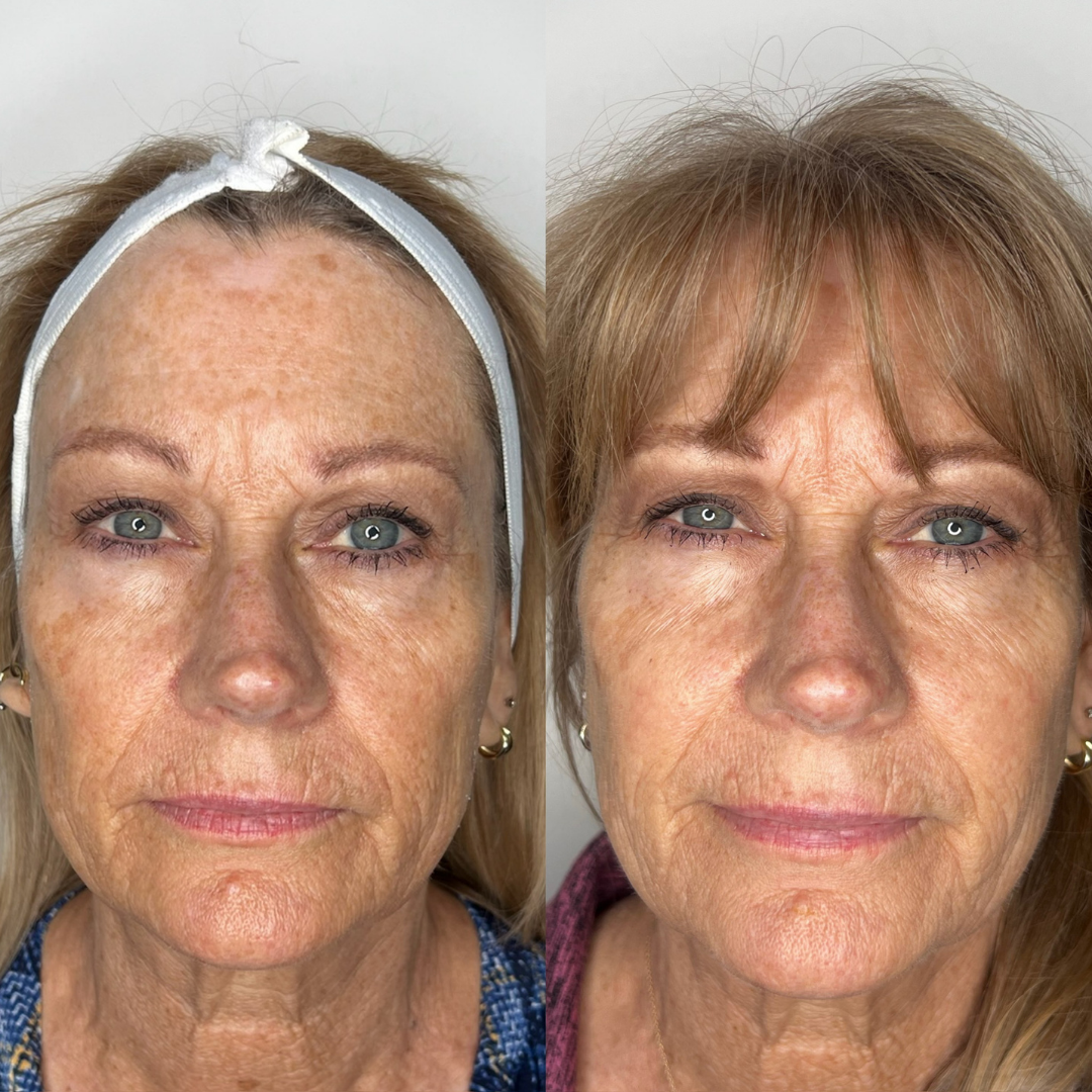 IPL Photofacial