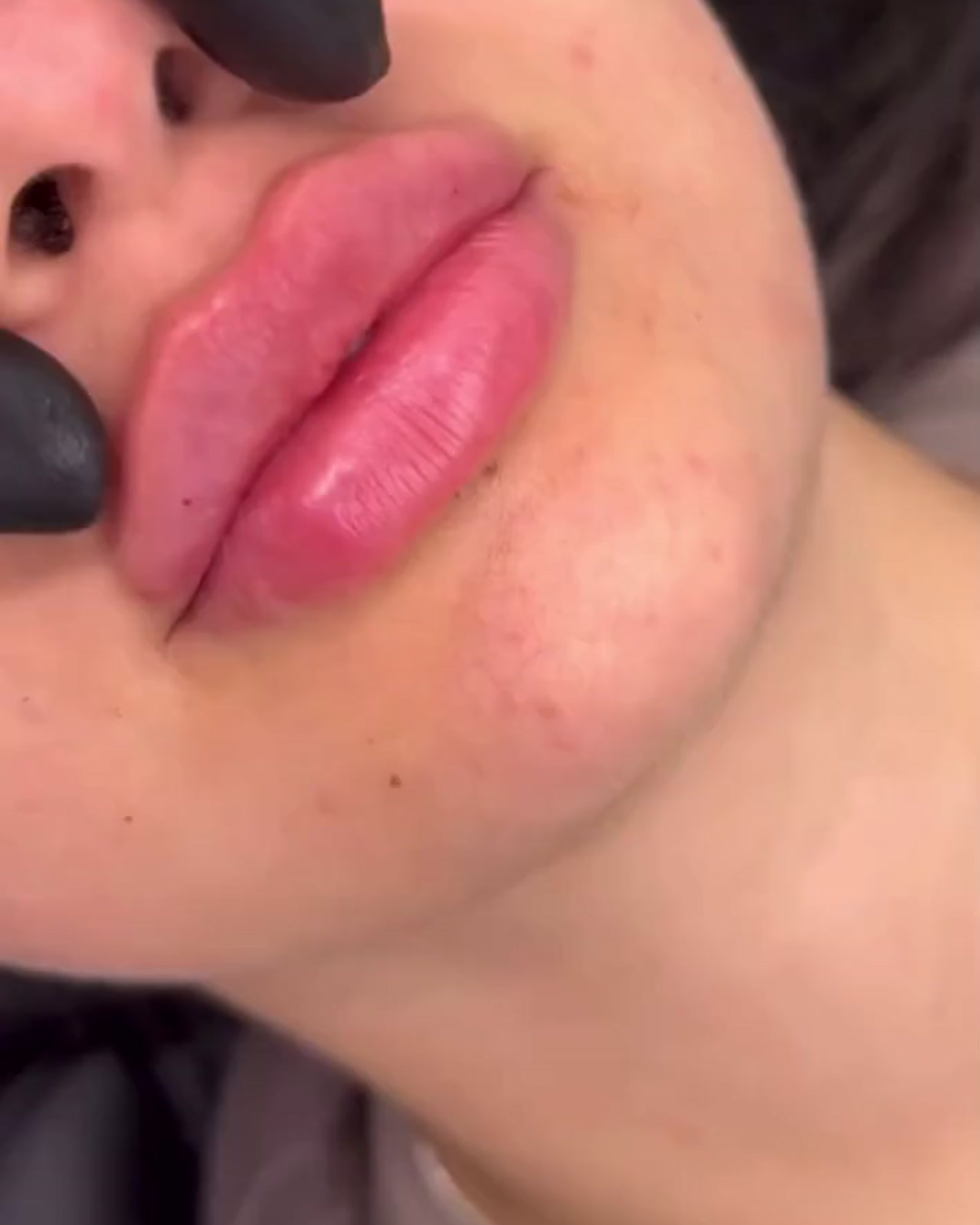 Are Lip Fillers Worth It?