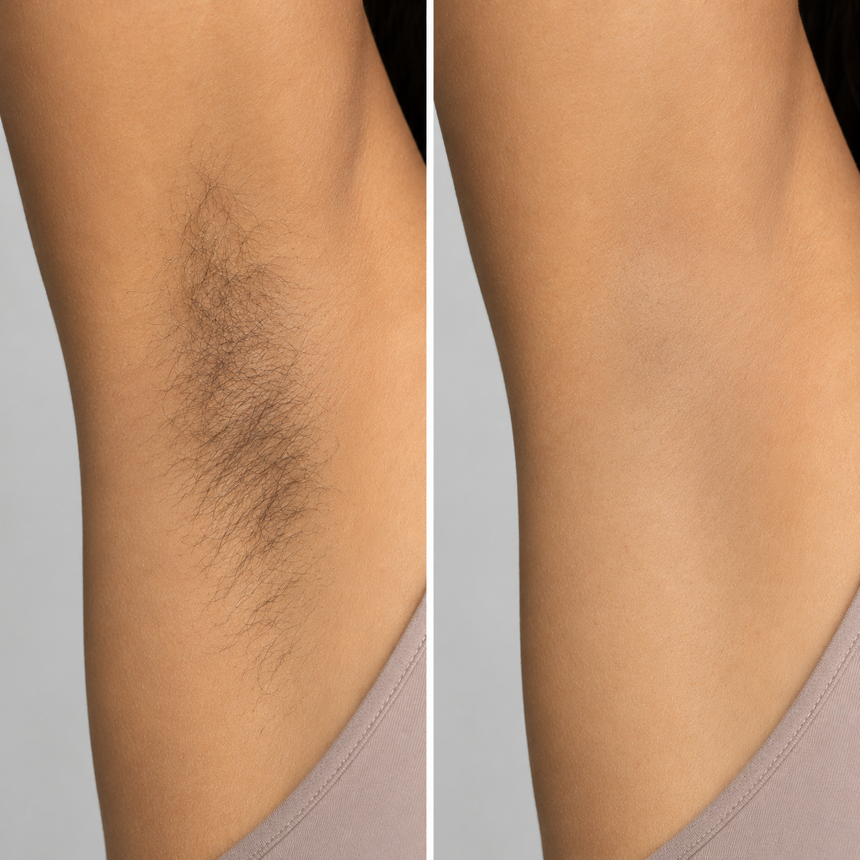 before and after underarm laser hair removal.png