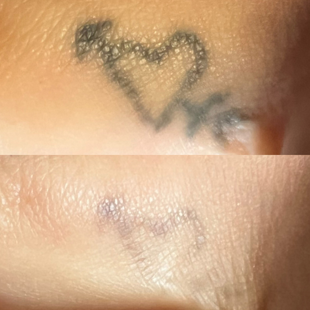 Laser Tattoo Removal