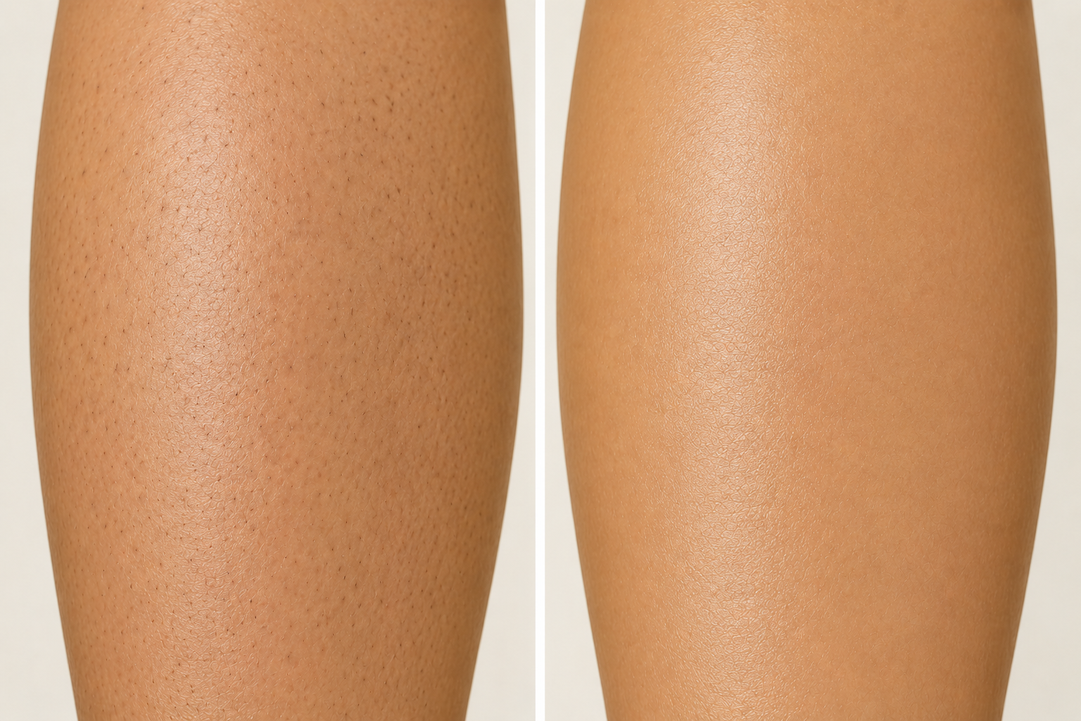 before and after laser hair removal leg hair denver dream medspa.png