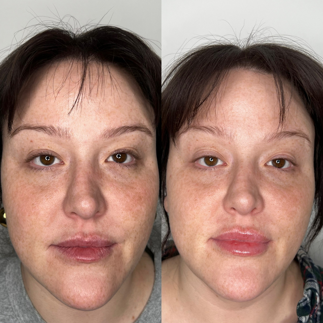 IPL Photofacial