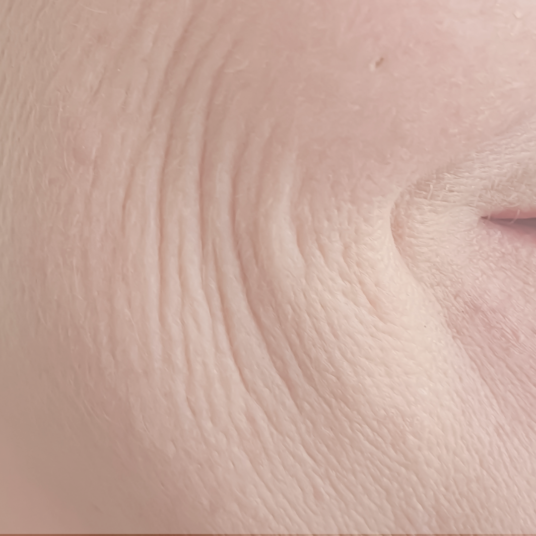 Fine Lines & Wrinkle Treatment in Denver | Dream Medspa Solutions ...