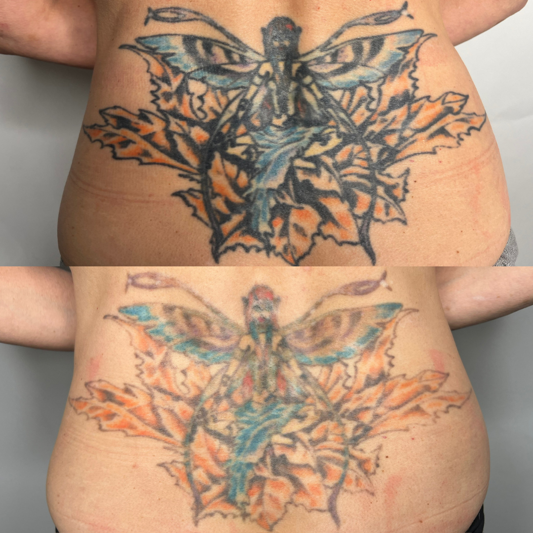 Laser Tattoo Removal