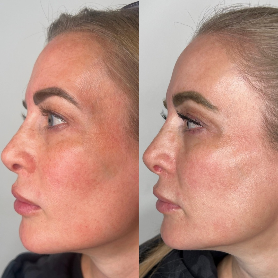 IPL Photofacial