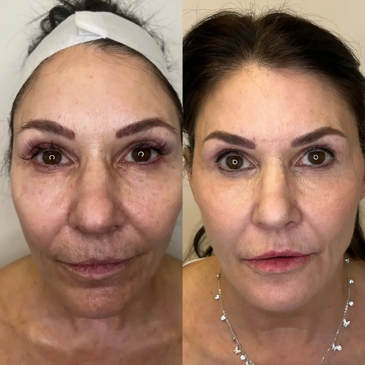Comparison of a woman's face before and after cosmetic treatment, showing improved skin texture and appearance.