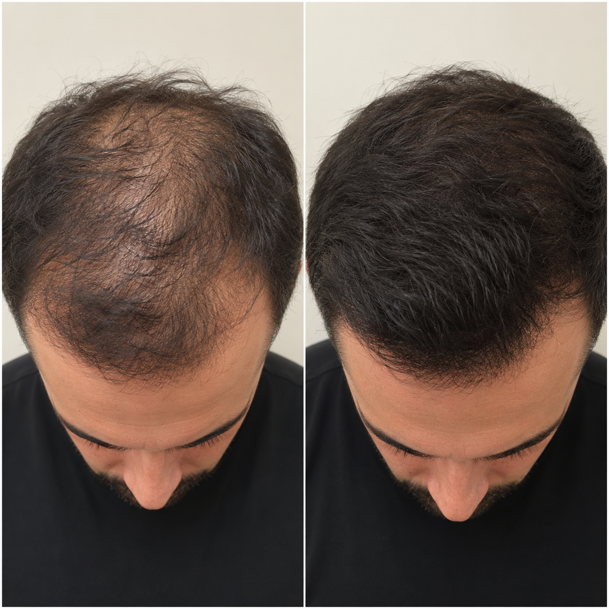 prp hair restoration man before and after.png