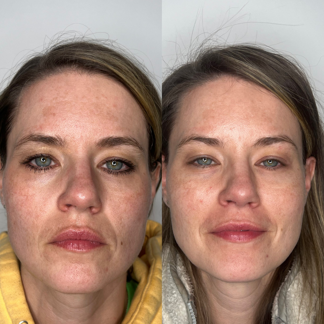 IPL Photofacial