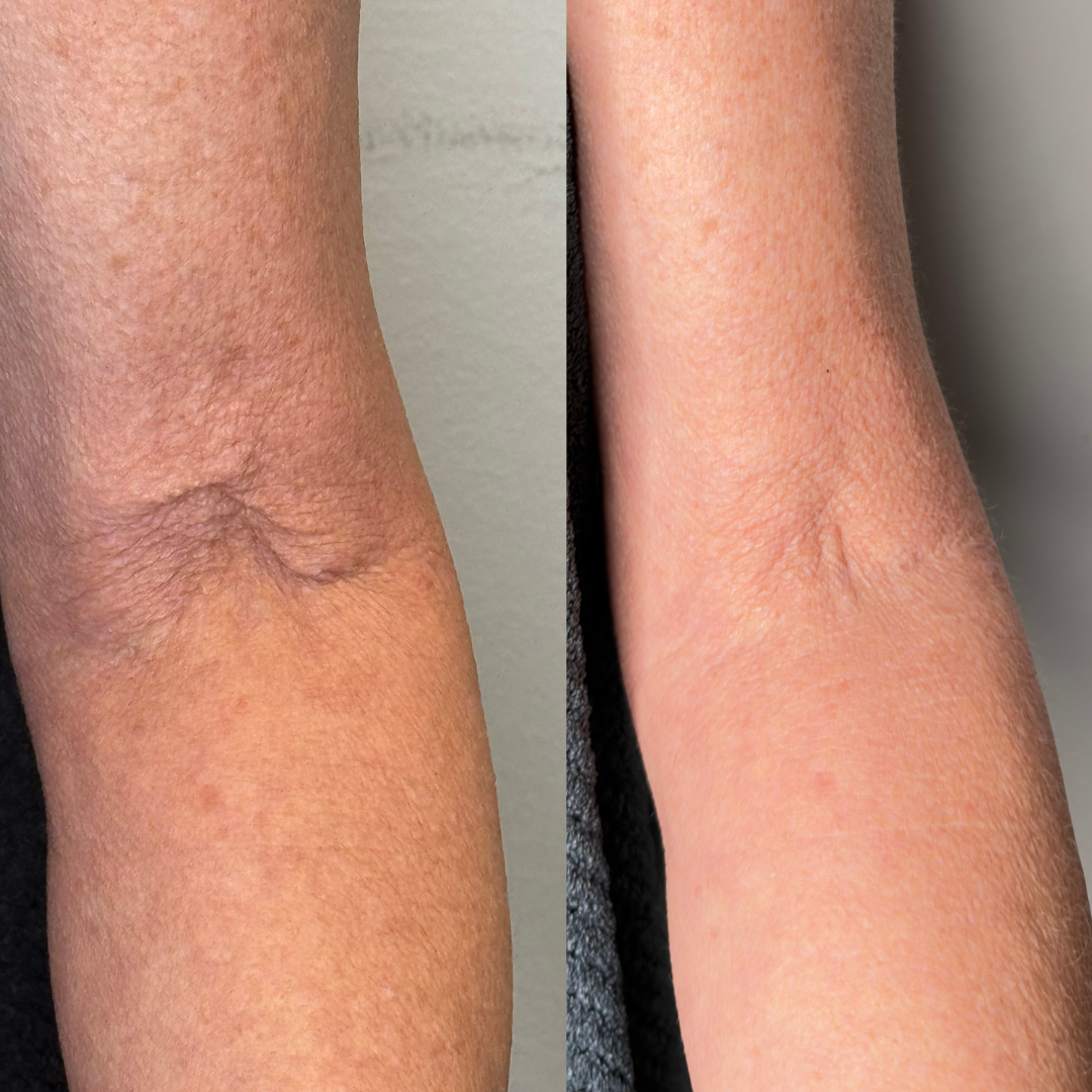 Close-up of a person's arm showing skin texture and elasticity before and after treatment, with improved skin smoothness and reduced wrinkles.