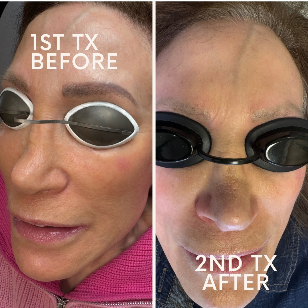Laser Tattoo Removal for Permanent Makeup
