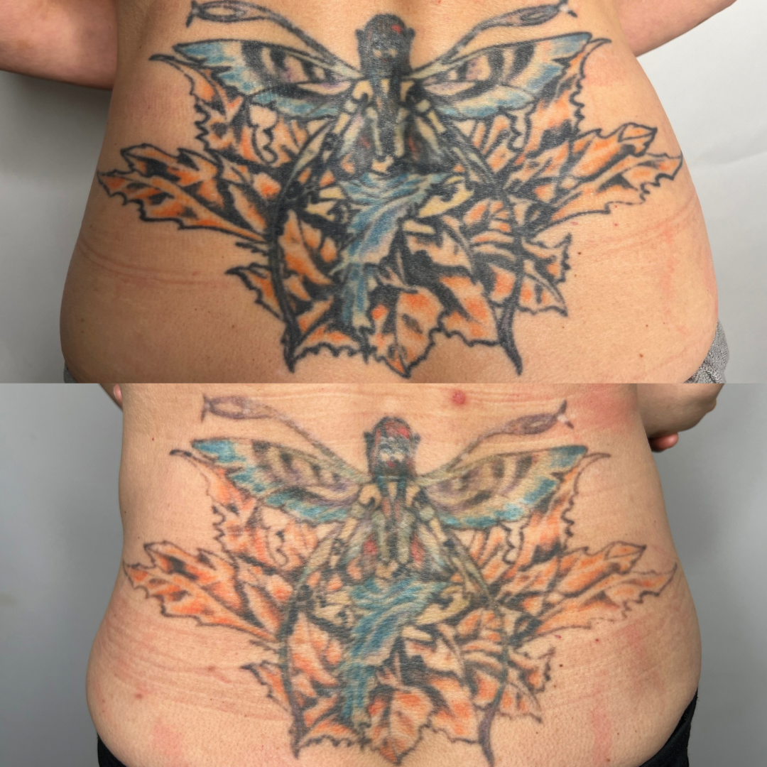 denver laser tattoo removal.PNG