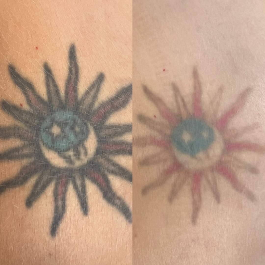 Laser Tattoo Removal