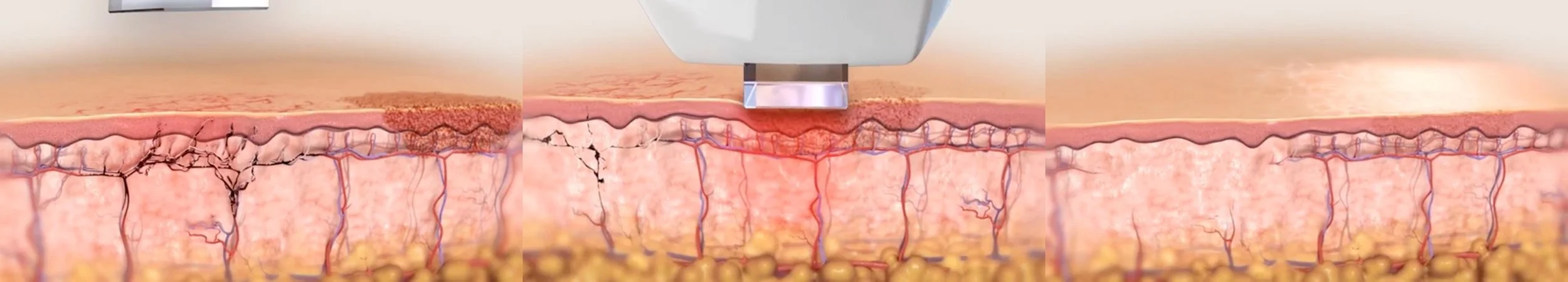 IPL skin science illustration showing light interacting with pigmentation and vascular structures