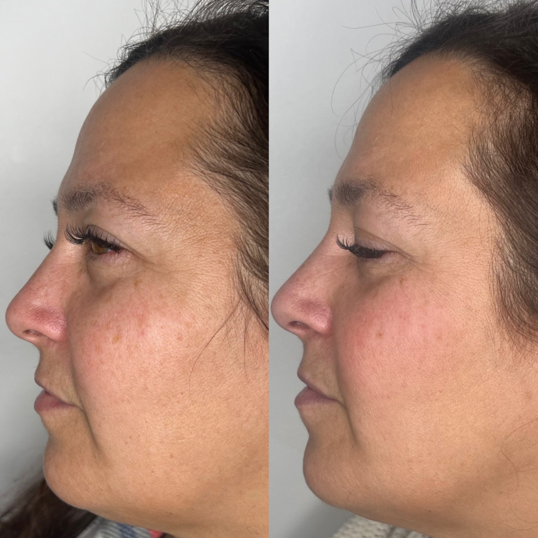 IPL Photofacial