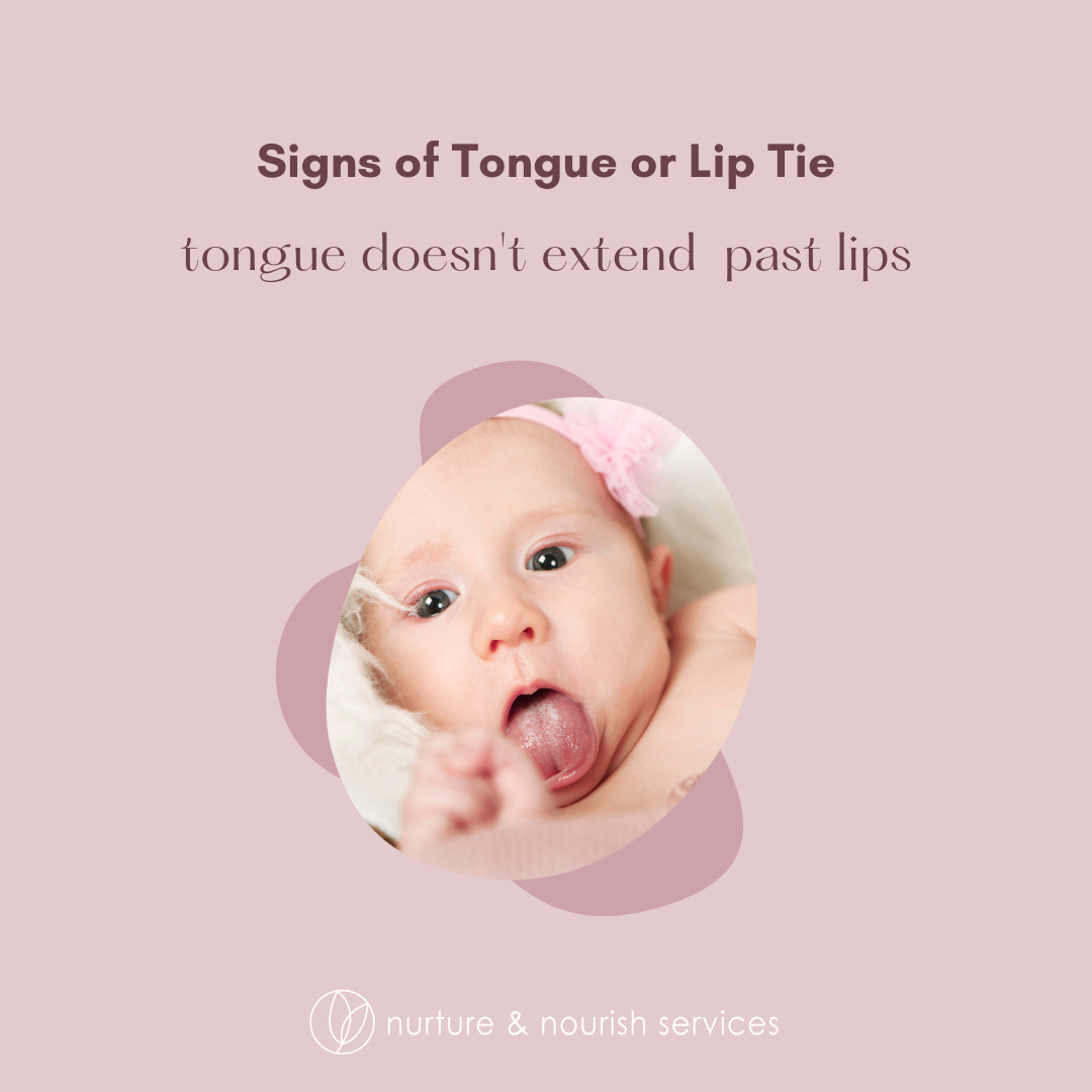 newborn tongue tie