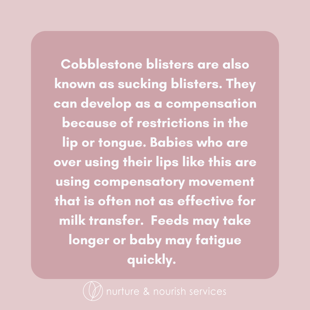 cobblestone blisters tongue tie.png