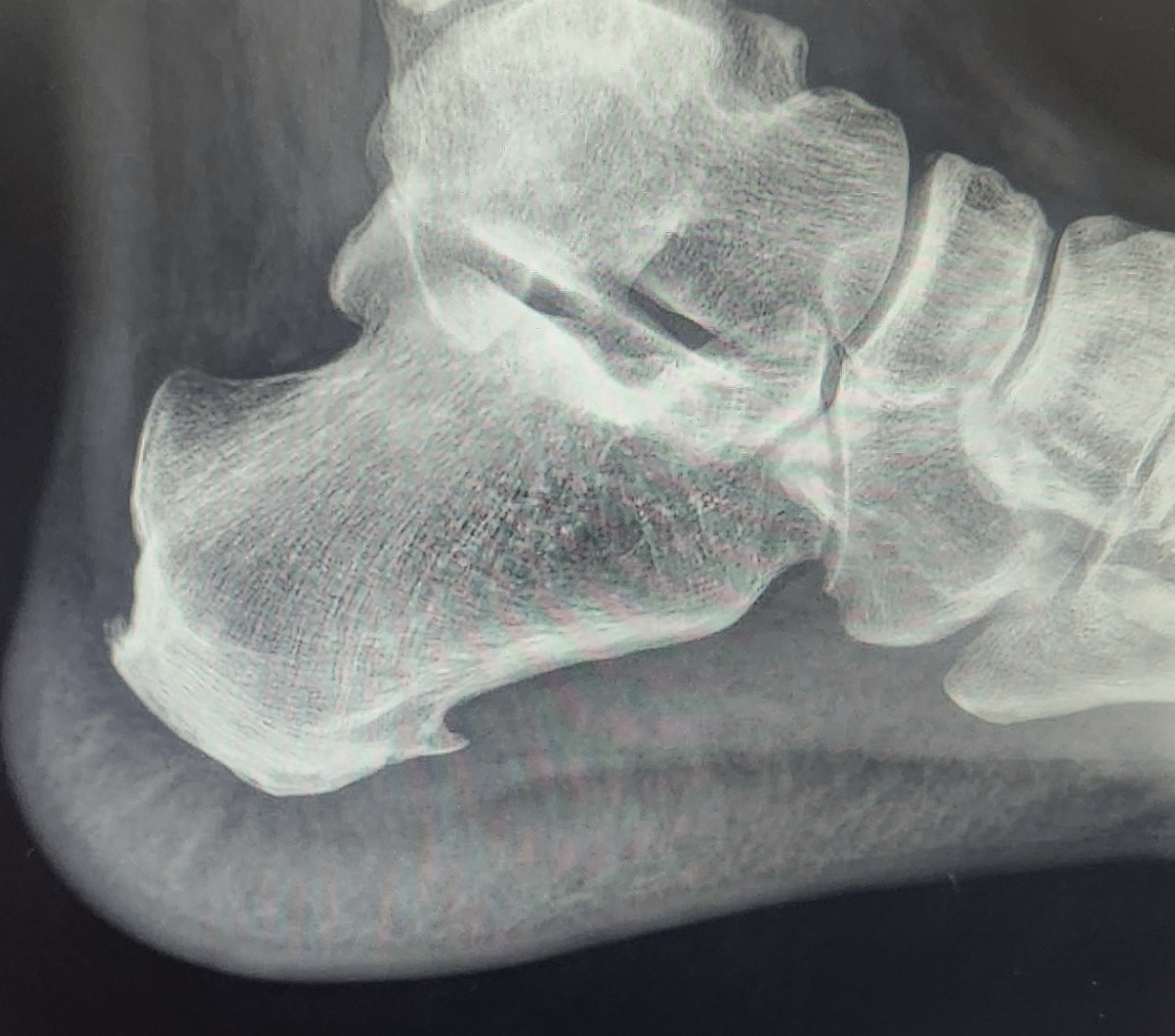 Your Heel Spur is Not Causing Your Heel Pain