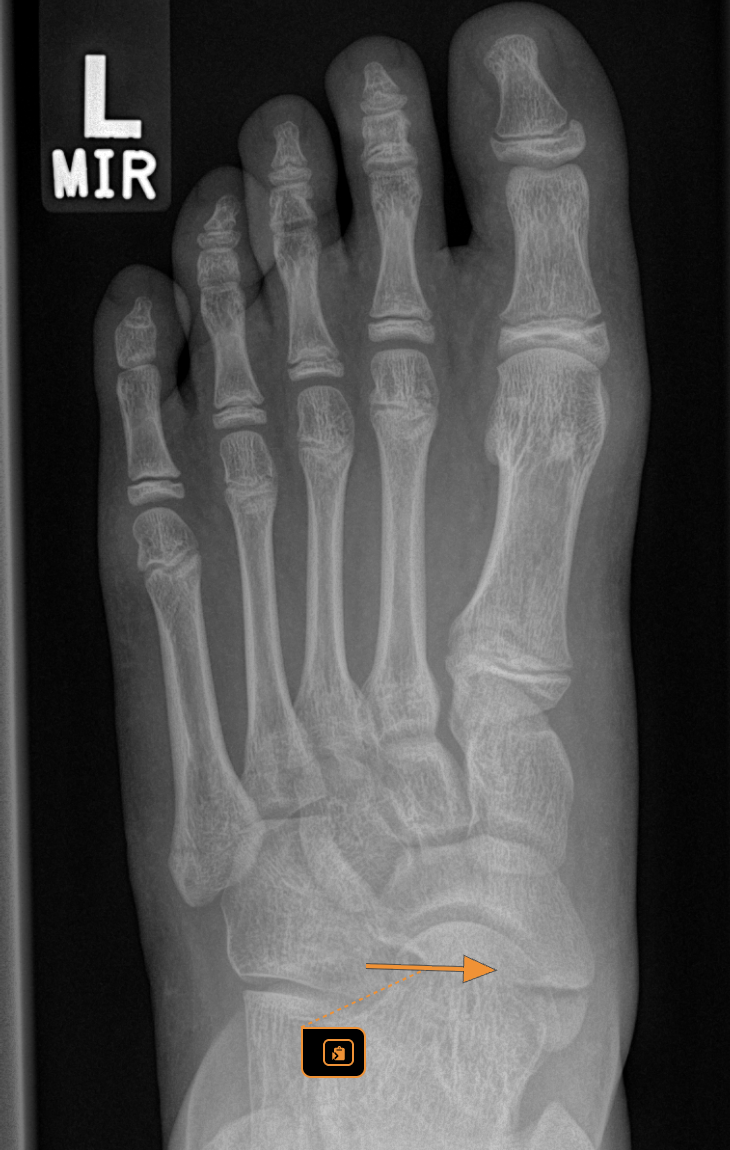 Accessory Navicular in Children