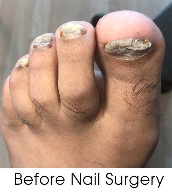 How Are Fungal Nail Infections Treated? - StoryMD