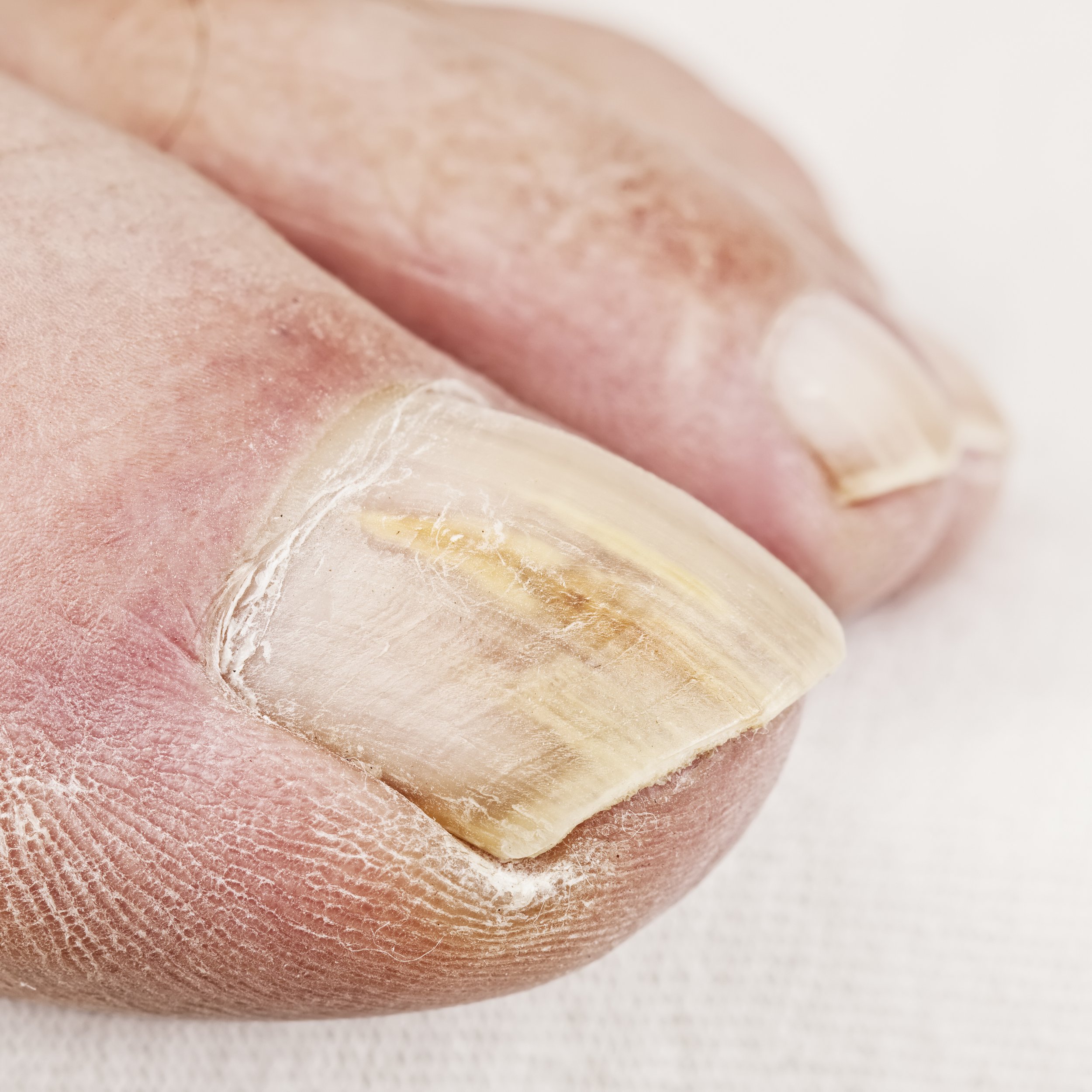 How to Get Rid of Toenail Fungus - JAWS podiatry