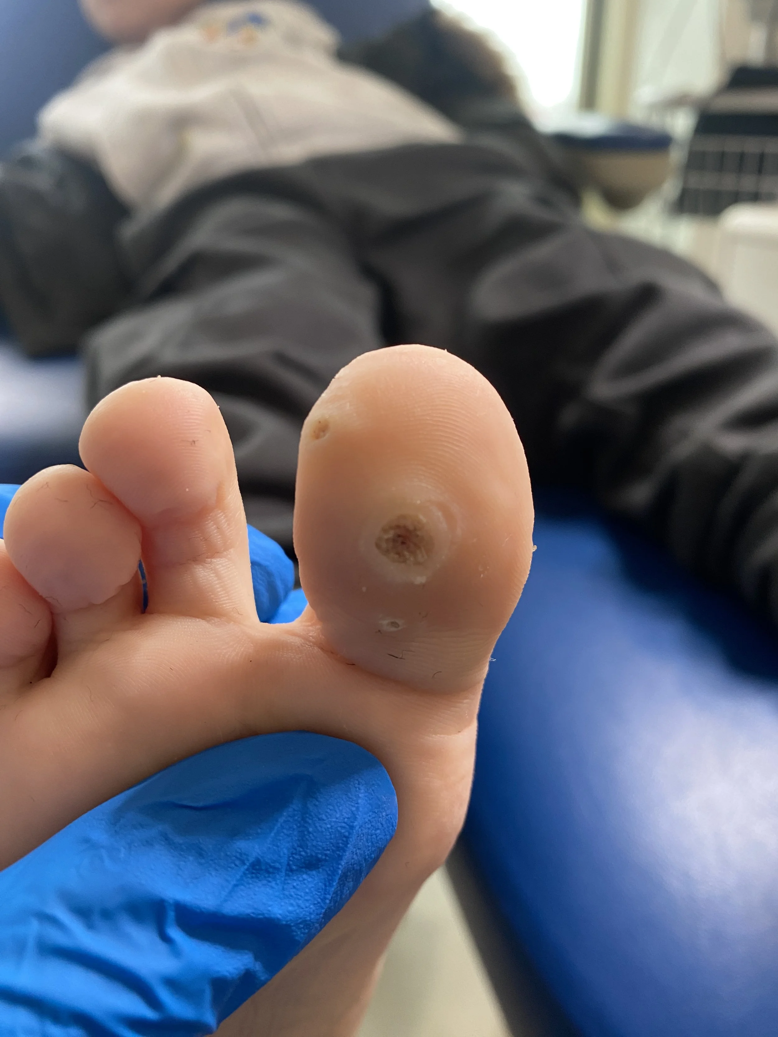 verruca children treatment