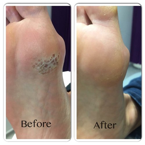 Needling for Verruca Treatment — Dr Foot Podiatry Clinic
