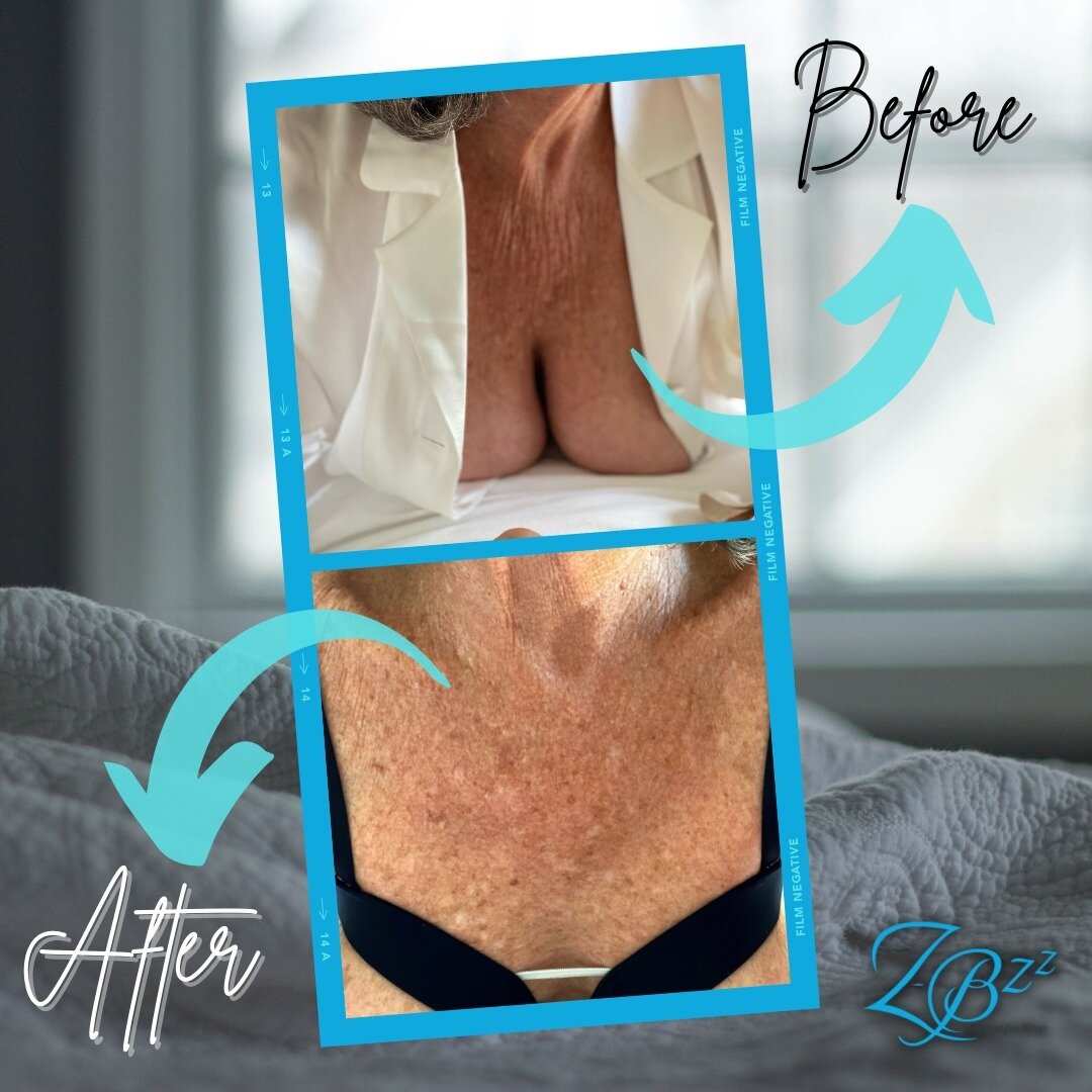 The results are in and they are ✨LIFE CHANGING ✨

We are excited to show you what our Zbzz Support Bras can do! 
These results were achieved while our client was sleeping. Giving &quot;Beauty Sleep&quot; a whole new meaning- our bras will give you a 