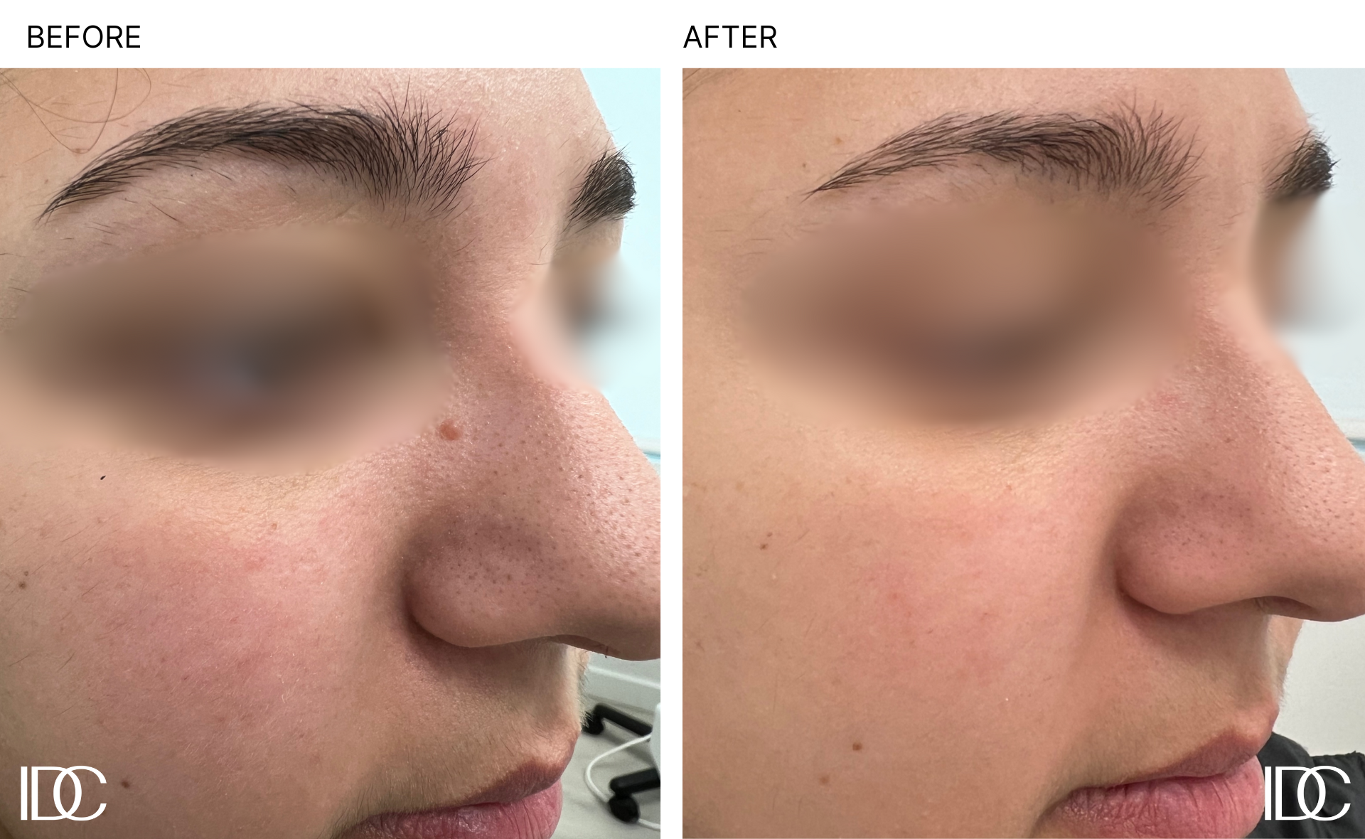 Interior-Dermatology-Centre-Patient-Before-Afters-Benign-Lesion-Removal.png