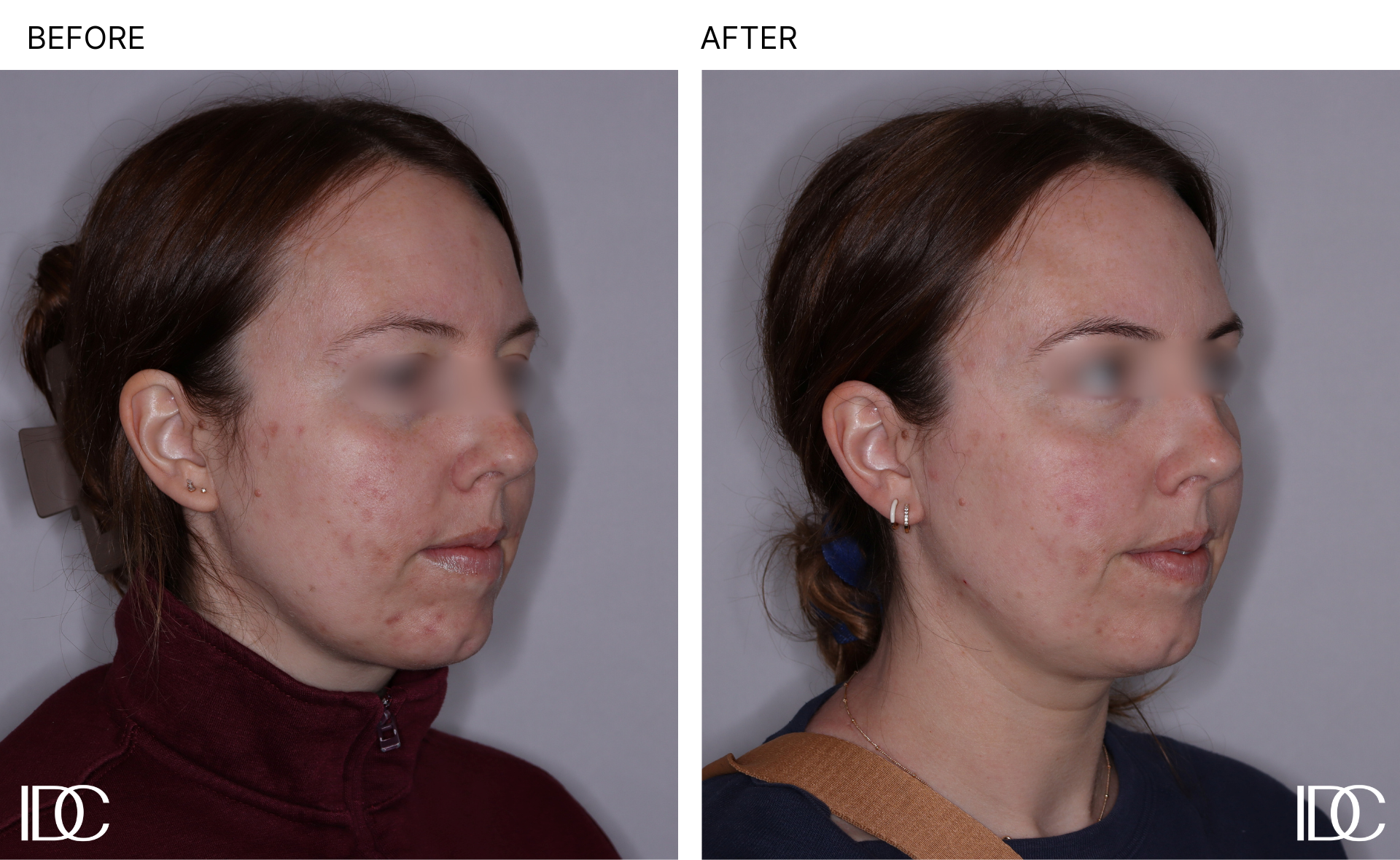 Acne & BBL pages - 2.png