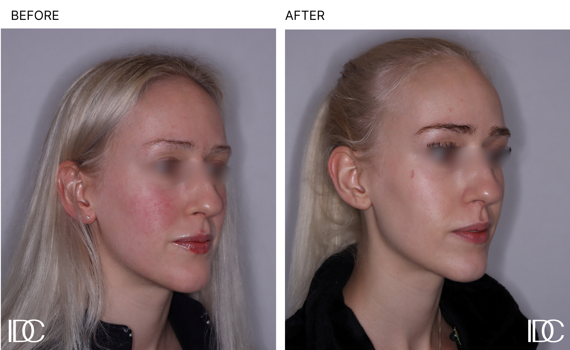 Acne & BBL pages - 1.png
