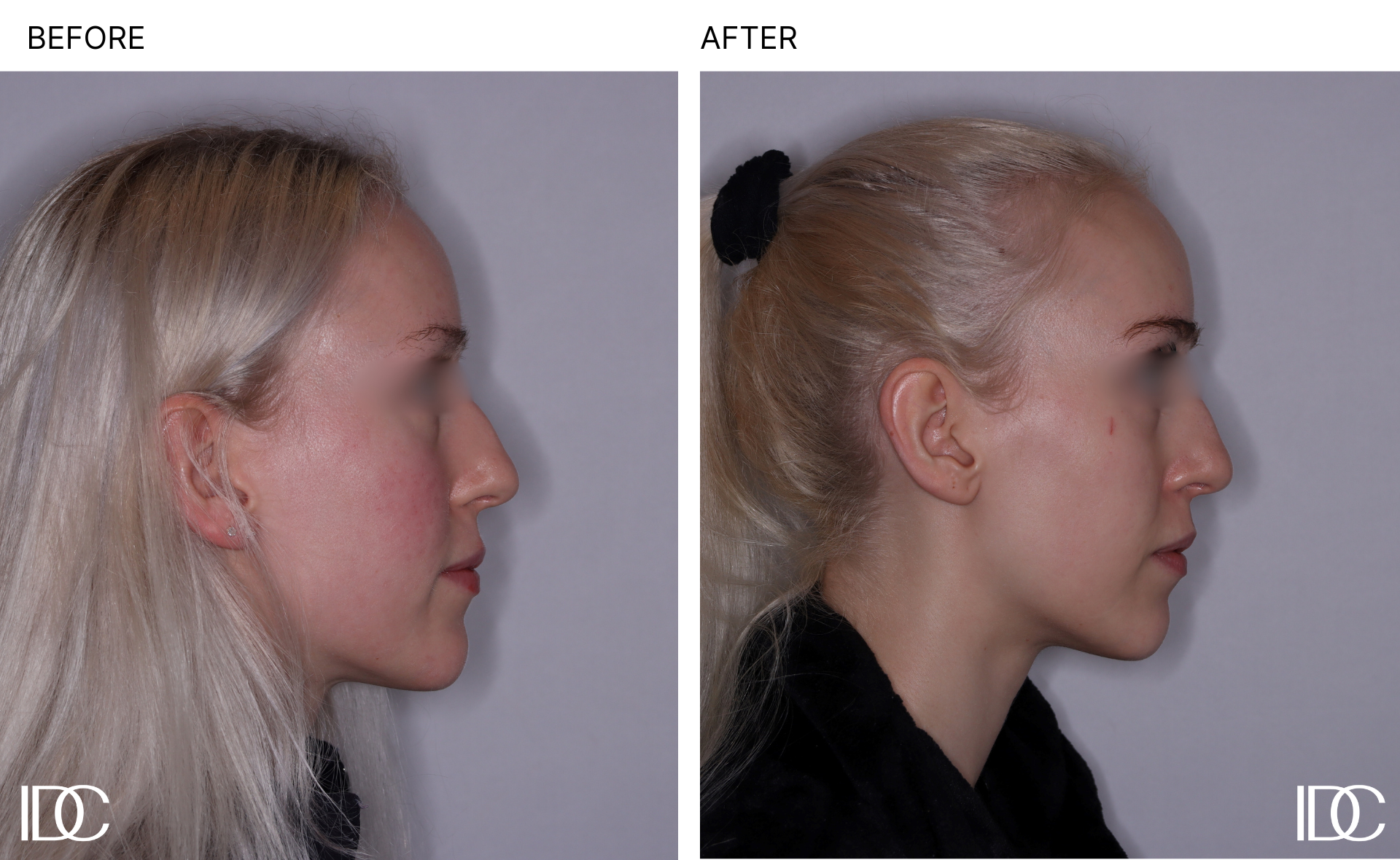 Acne & BBL pages - 2.png