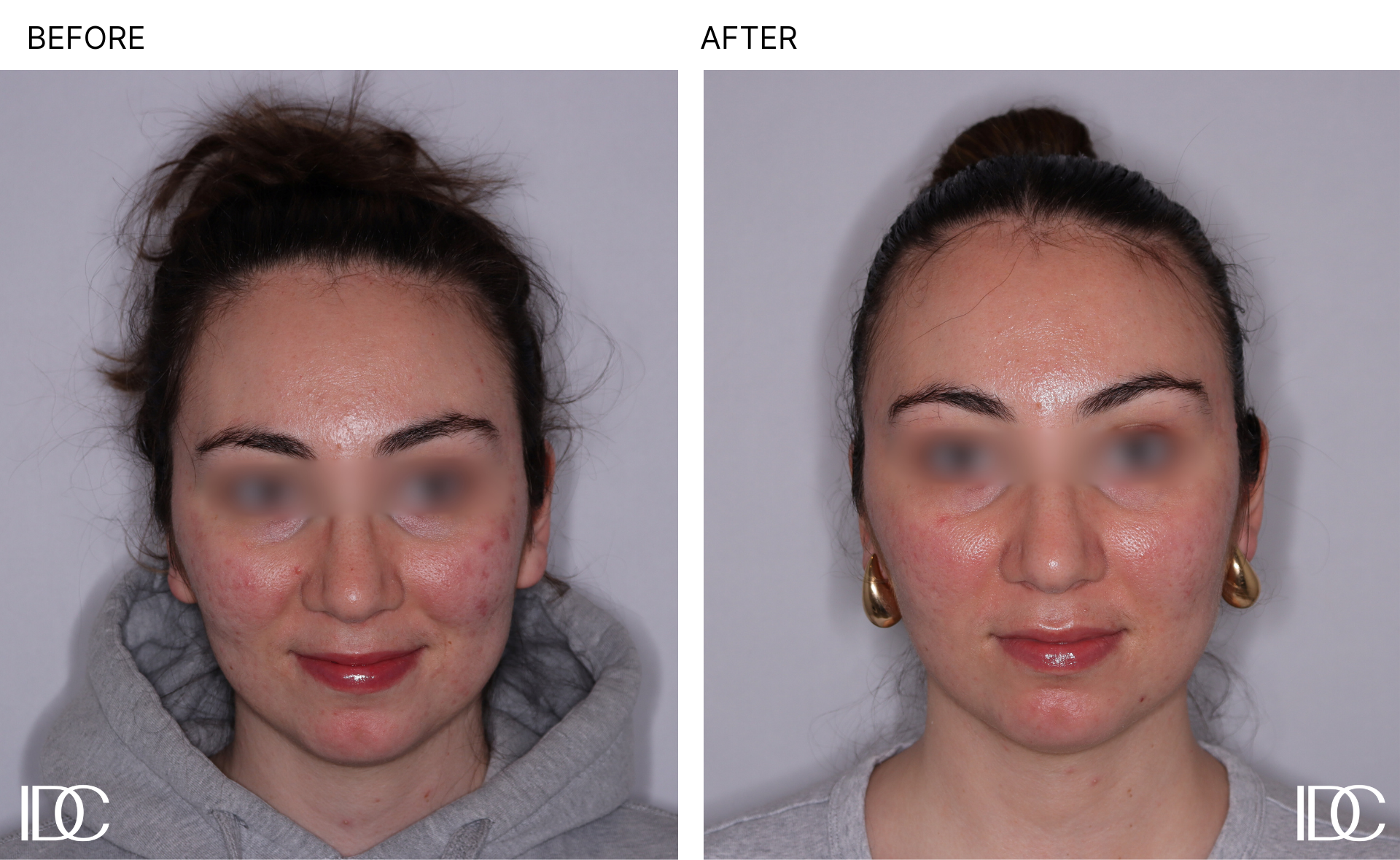 Acne & BBL pages - 1.png