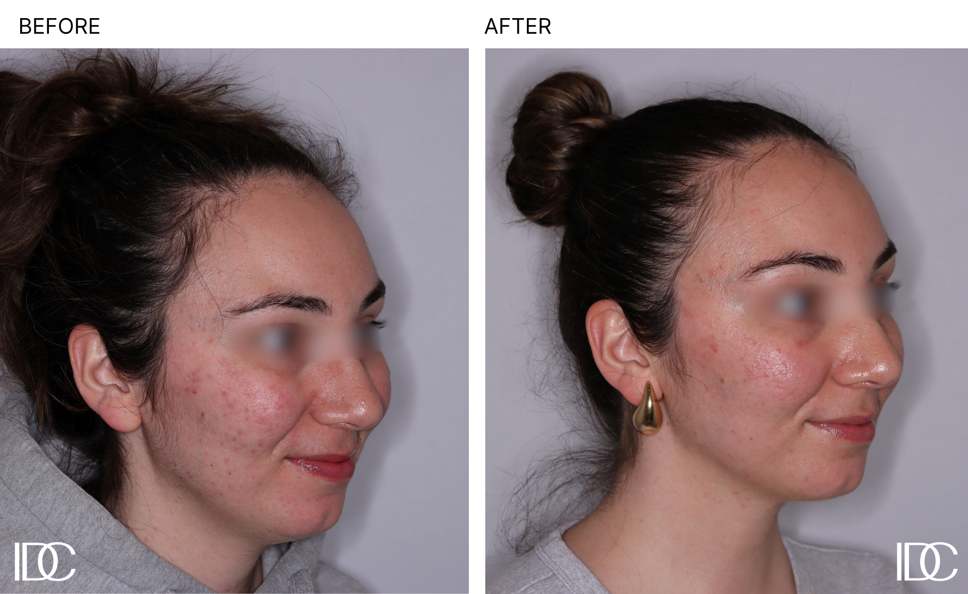 Acne & BBL pages - 2.png