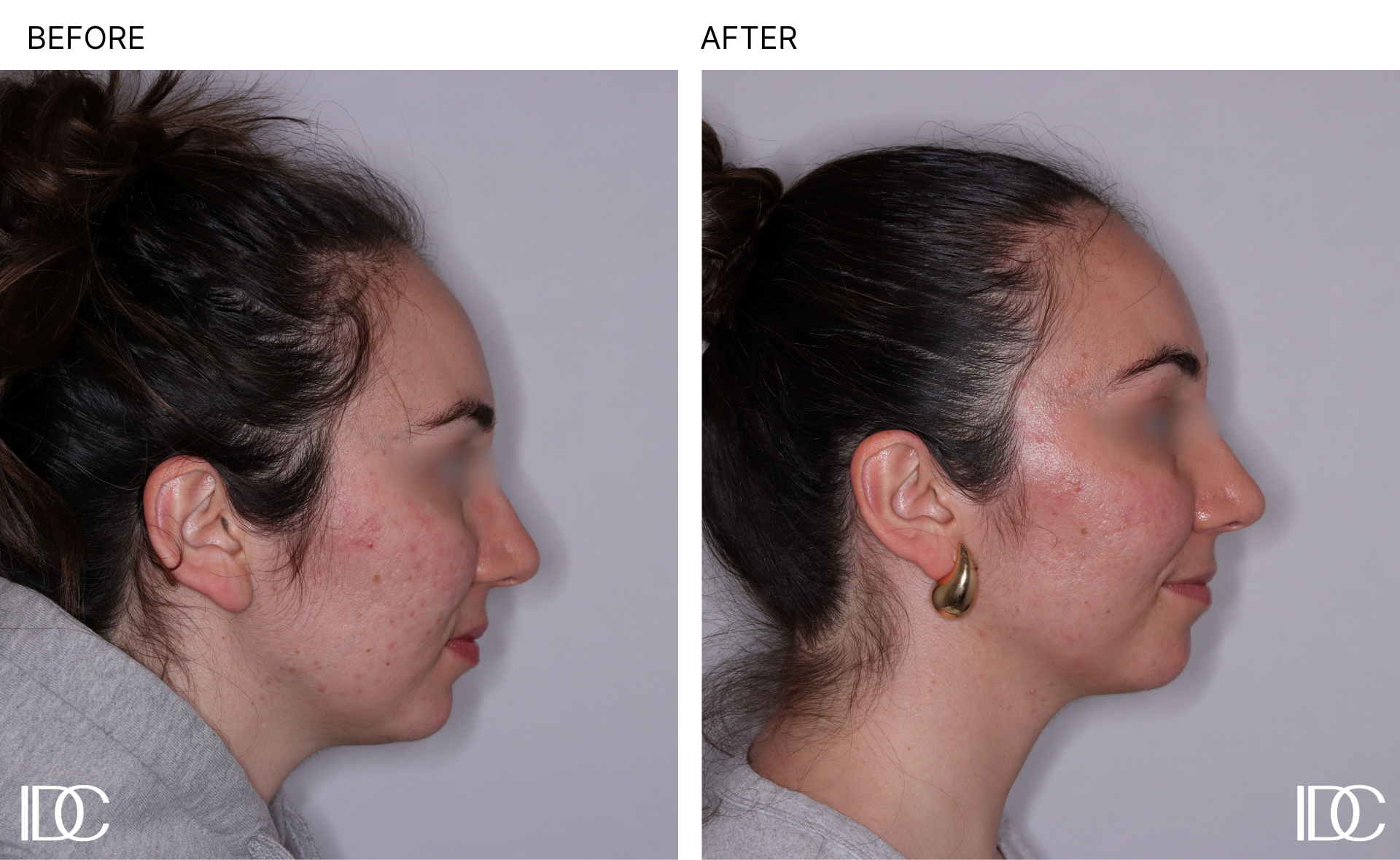 Acne & BBL pages - 3-1.png