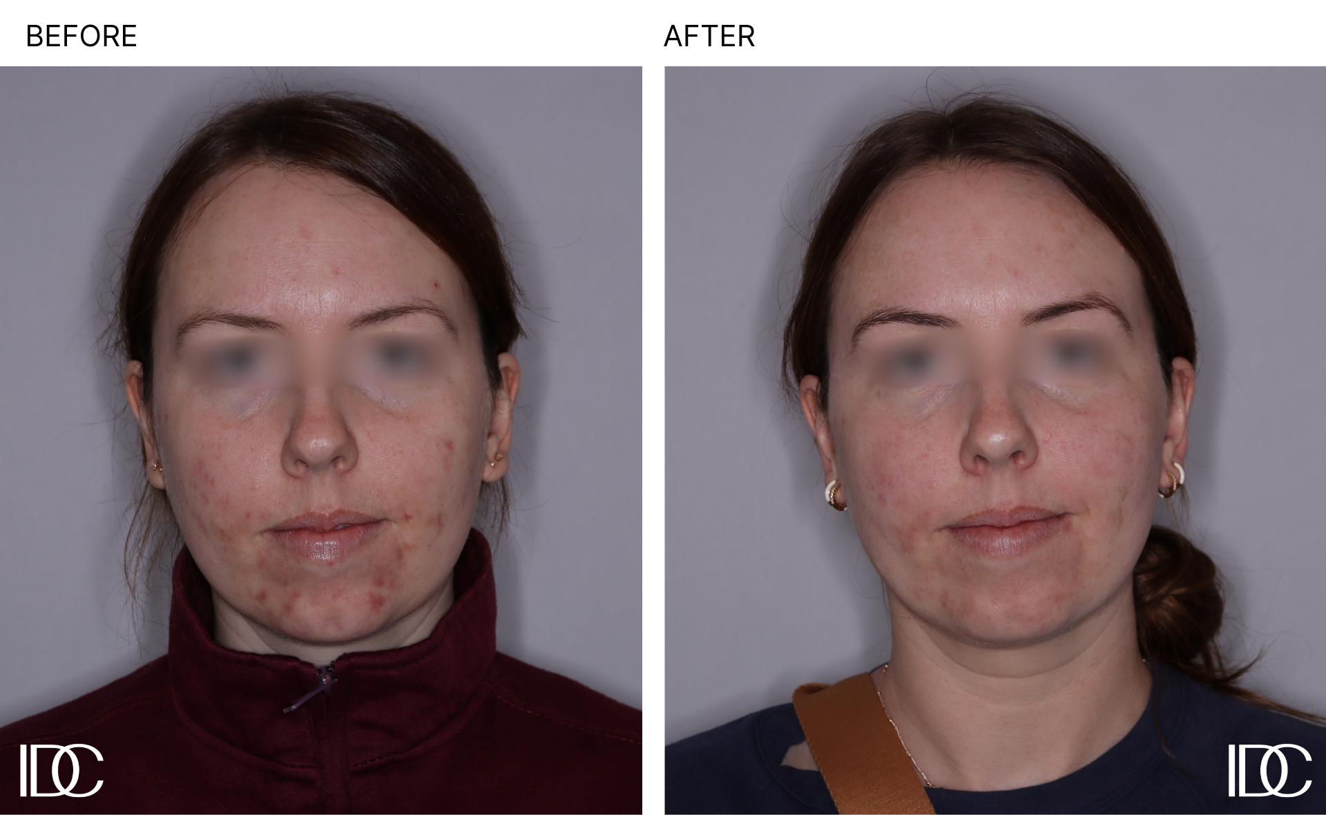 Acne & BBL pages - 1.png